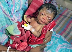 Em bé mới sinh ở Bangladesh trông như ông lão
